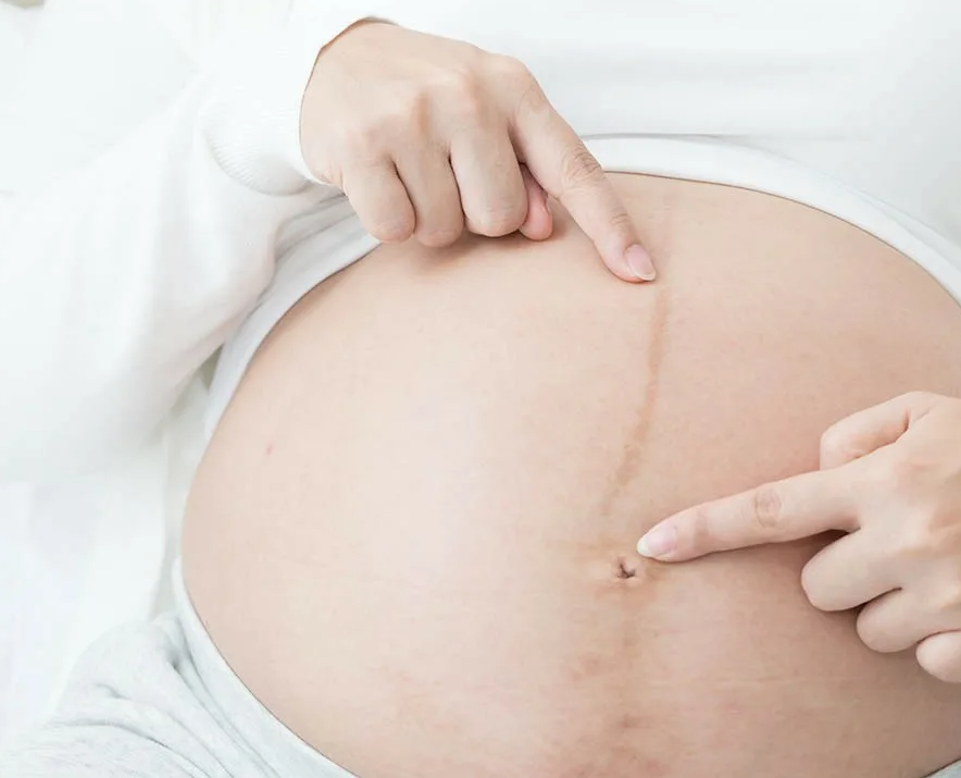 Linha nigra: saiba mais sobre esse fenômeno tão comum na gravidez